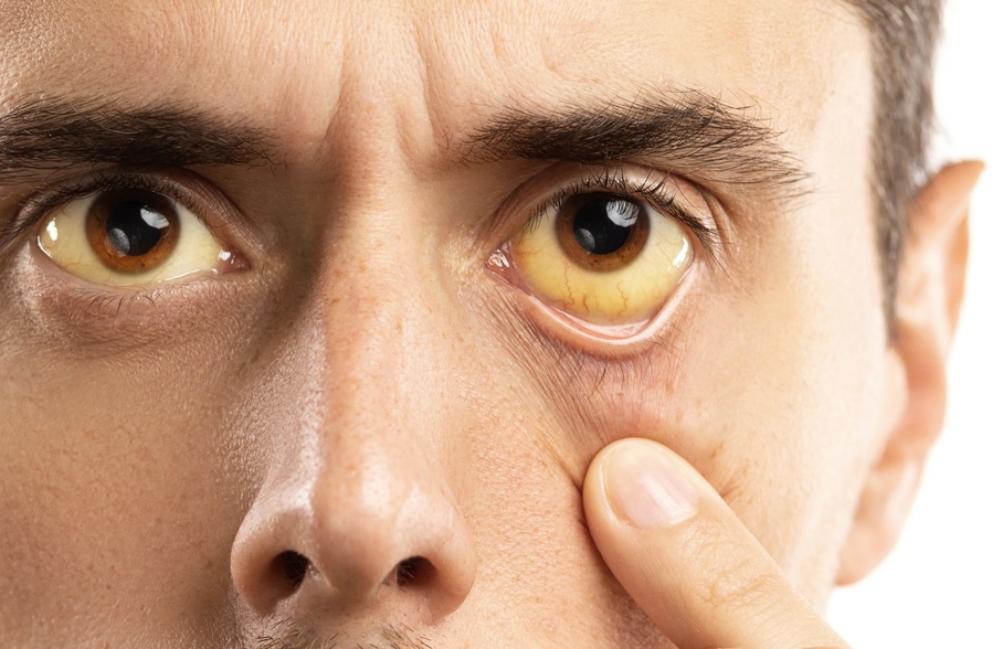  یرقان کی تشخیص کیلئے جدید ڈیوائس متعارف